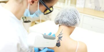 Removendo Tatuagem Feminina