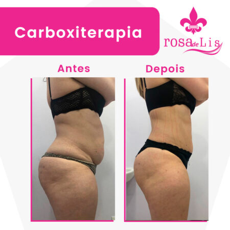 carboxiterapia-para-celulite