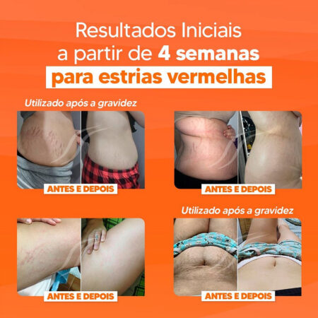 estrias-vermelhas-saiba-tudo-sobre-como-prevenir-e-eliminar-as-estrias