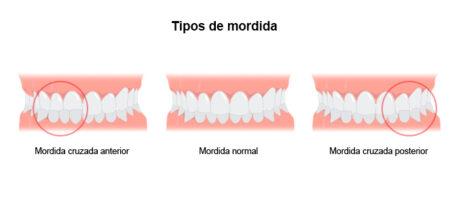 mordida-cruzada-conheca-as-causas-sintomas-e-formas-de-tratamento